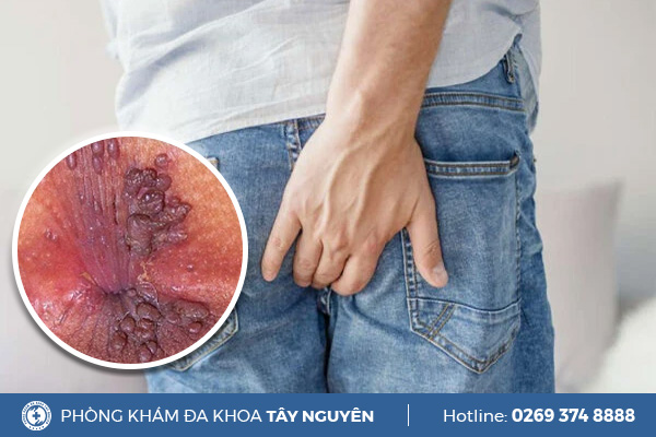 Cẩn thận với những biểu hiện sùi mào gà ở hậu môn