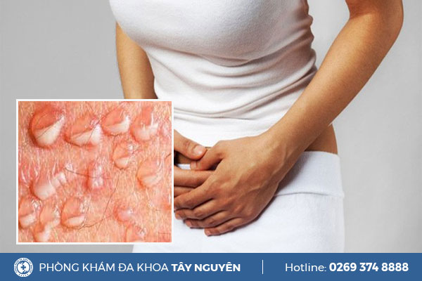 Dấu hiệu nhận biết mụn rộp sinh dục ở nữ