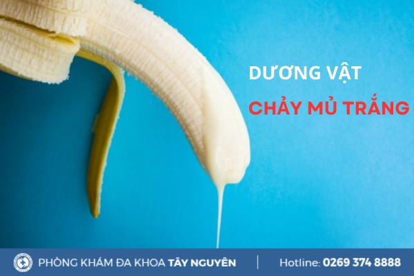 Dương vật chảy mủ trắng nguy cơ cao mắc bệnh lậu?