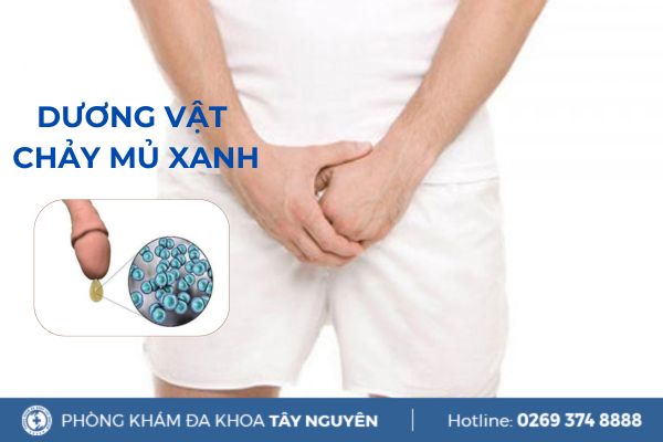 Dương vật chảy mủ xanh cảnh báo bệnh lý xã hội nguy hiểm?
