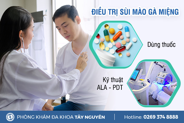 Nhận biết sùi mào gà ở miệng và cách chữa