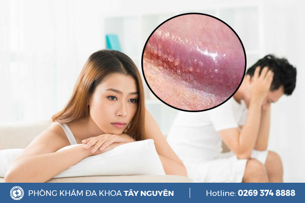 Những điều cần biết về gai sinh dục ở nam và nữ giới