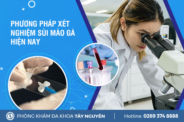 Phương pháp xét nghiệm sùi mào gà là gì?