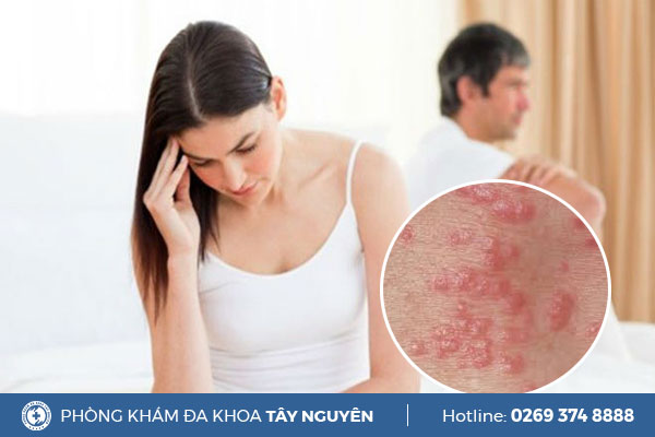 Tư vấn bệnh tình dục dễ mắc và cách chữa trị hiệu quả